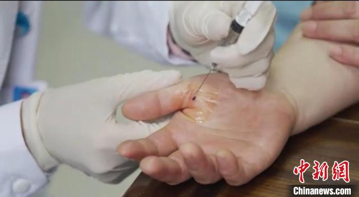 嘉善群眾體驗小針刀?！〖紊平y(tǒng)戰(zhàn) 供圖